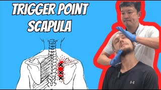 TRIGGER POINT SCAPULA [upl. by Arised343]