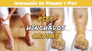 ⚕️🩺 HINCHAZÓN DE PIES Y TOBILLOS Causas y Recomendaciones [upl. by Adehsar]