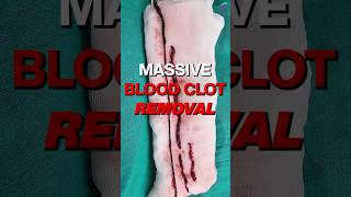 Shocking Footage Massive Blood Clot Removal From Artery shortsviral vascularsurgeon [upl. by Brinkema]