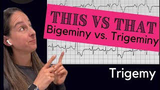 Bigeminy vs Trigeminy 🫀 [upl. by Lyons]