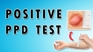 Positive PPD Test [upl. by Kreegar]