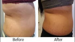 VelaShape cellulite treatment before and after [upl. by Nikolaos553]