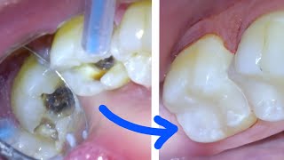 🦷 How a CAVITY amp TOOTH FILLING Procedure Are Done Right by A Dentist White Resin Composite Class 2 [upl. by Thadeus]