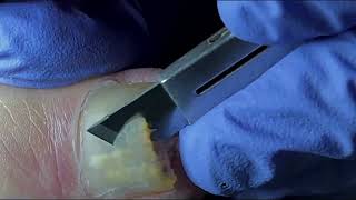 Ingrown Toenail Removal  Pedicure Treatment and Very Satisfying  Best Satisfying Nail Cutting [upl. by Bringhurst]