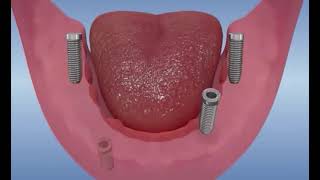 Toutes les dents sur 4 implants  All on four dentaire [upl. by Arlon470]