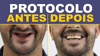 8 Casos de Implantes Protocolo  Antes e Depois [upl. by Witte2]