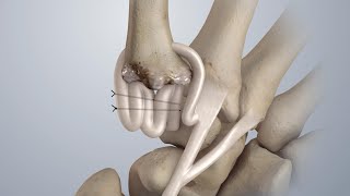 Osteoarthritis of the Thumb Surgical Treatment LRTI [upl. by Weed]