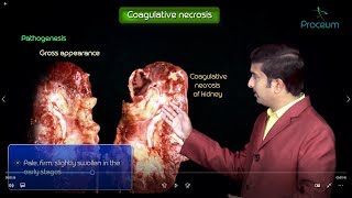 Necrosis and types of Necrosis  General pathology  Animated usmle videos [upl. by Ogu]