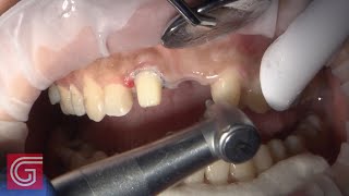 Placing BruxZir Esthetic ANTERIOR Bridge 811 Part 3 of 3 [upl. by Noitsuj]