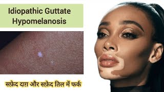 Idiopathic Guttate Hypomelanosis  सफ़ेद तिल और सफ़ेद दाग़ में फर्क IGH vitiligo leucoderma सफ़ेद [upl. by Annahoj50]