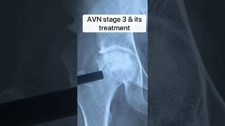 Best treatment for stage 3 AVN avascularnecrosis hipreplacementsurgery drpankajwalecha [upl. by Honey]