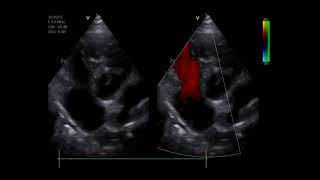 Pulmonary Hypertension in a dog [upl. by Zzahc479]