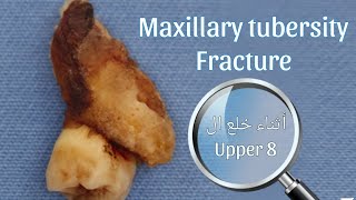 كسر ال maxillary tuberosity أثناء خلع ال Upper 8 هتتعامل ازاي ؟ [upl. by Mcmullan986]