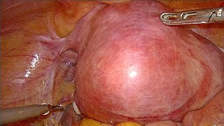 Large fibroid uterus TLH unedited [upl. by Rhona]