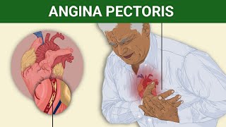 Angina pectoris EtiologyClinical FeaturesPathophysiologyMedical Management  Complication [upl. by Aistek]