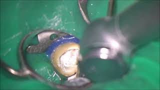 Sealer based obturation of Cshaped root canals in a retreatment case [upl. by Anaile988]