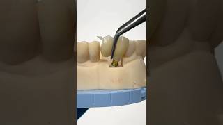 Zen Enamel Pontic Bridge with Occlusal Wing EnvisiontecMain envisiontec lsk121shorts [upl. by Enerak]