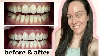 I had laser teeth whitening let’s talk about the pain [upl. by Gobert]