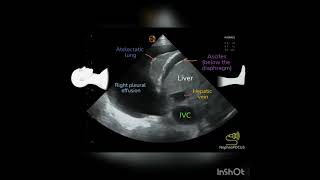 Pleural effusion on Ultrasound POCUS [upl. by Nwahsirhc787]