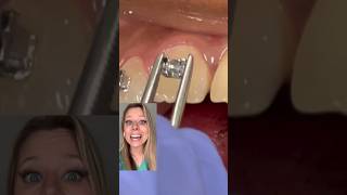 Does it HURT to get BRACES PUT ON braces orthodontics teeth [upl. by Bertolde]