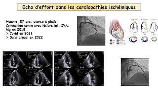 Sportif asymptomatique avec cardiopathie VO2 contre écho d’effort que choisir [upl. by Carissa]