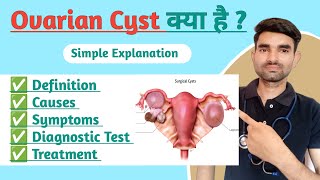 Ovarian Cyst in Hindi  Causes Symptoms And Treatment of Ovarian Cyst [upl. by Ynohtnael]