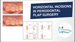 BASIC INCISIONS HORIZONTAL INCISIONS IN PERIODONTAL FLAP SURGERY DR ANKITA KOTECHA [upl. by Mireille678]