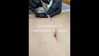 Mesoterapia corporal [upl. by Lynnet]