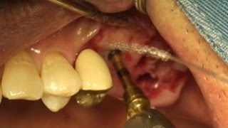 Gentle crestal approach using DASK amp Osteotome [upl. by Lebatsirhc]