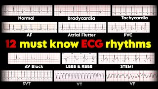 12 must know ECG rhythms  ECGEKG interpretation • Daily Cardiology [upl. by Aham698]