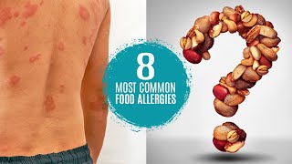 What are the 8 Most Common Food Allergies Symptoms Treatment amp Testing [upl. by Oona]