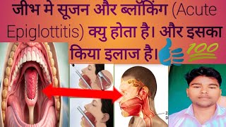 जीभ मे सूजन और ब्लाॅकिंग Acute Epiglottitis क्यु होता है। और इसका किया इलाज है। epiglottiris [upl. by Trout]