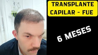 TRANSPLANTE CAPILAR  FUE 6 MESES  ESTOU SATISFEITO COM O RESULTADO [upl. by Allecsirp]