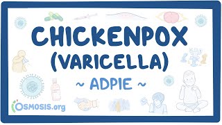 Chickenpox Varicella Nursing Process ADPIE [upl. by Howlond]