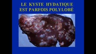 KYSTE HYDATIQUE DU FOIE [upl. by Akihsal]