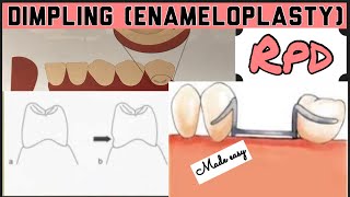 DIMPLING ENAMELOPLASTY II PROSTHETIC MOUTH PREPARATION II REMOVABLE PARTIAL DENTURE I PROSTHODONTICS [upl. by Natalia38]