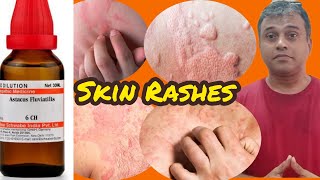 Top medicine for Skin rashes and urticaria [upl. by Polak]