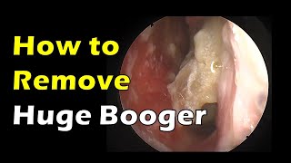 how to remove huge booger [upl. by Kiyohara]