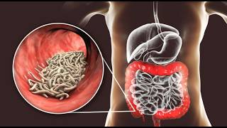 Sinais que você tem PARASITAS vivendo dentro do seu corpo sinais e sintomas de vermes [upl. by Ario174]