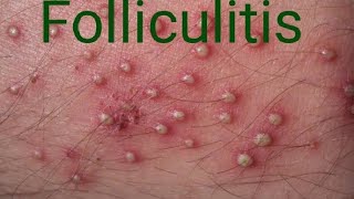 Folliculitis furuncle carbuncle [upl. by Dronel]