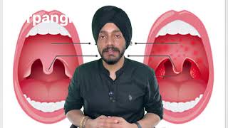 Herpangina explained by Dr Arshdeep Singh [upl. by Htiekal741]