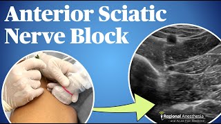 UltrasoundGuided Anterior Sciatic Nerve Block [upl. by Selden]