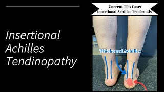 Insertional Achilles Tendinopathy [upl. by Aro677]