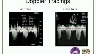 Optimizing Your Echo Images amp Doppler Evaluations webcast [upl. by Siraj869]