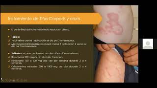 Micosis superficiales Dermatofitos [upl. by Imailiv]