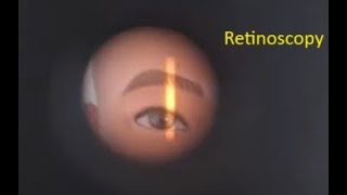 Retinoscopy Red Reflex Simplified [upl. by Ori]