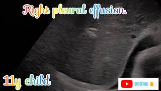 Right pleural effusion in usg [upl. by Soisinoid]