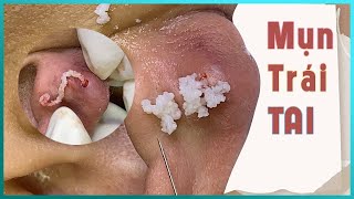 Big Cystic Acne Blackheads Extraction Blackheads amp Milia Whiteheads Removal Pimple Popping [upl. by Aekin]