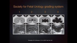 Grading Hydronephrosis on Bedside Ultrasound [upl. by Schoenburg84]