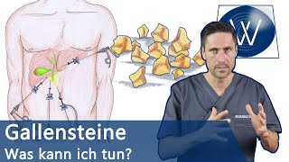 Gallensteine Was nun Typische Symptome Alles zur Entstehung amp Tipps zur natürlichen Entfernung [upl. by Llirrem]